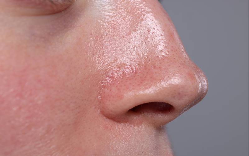 Da đổ dầu và bí tắc sau mùa nóng cần được làm sạch dịu nhẹ, dưỡng ẩm phù hợp để giảm nguy cơ nổi mụn