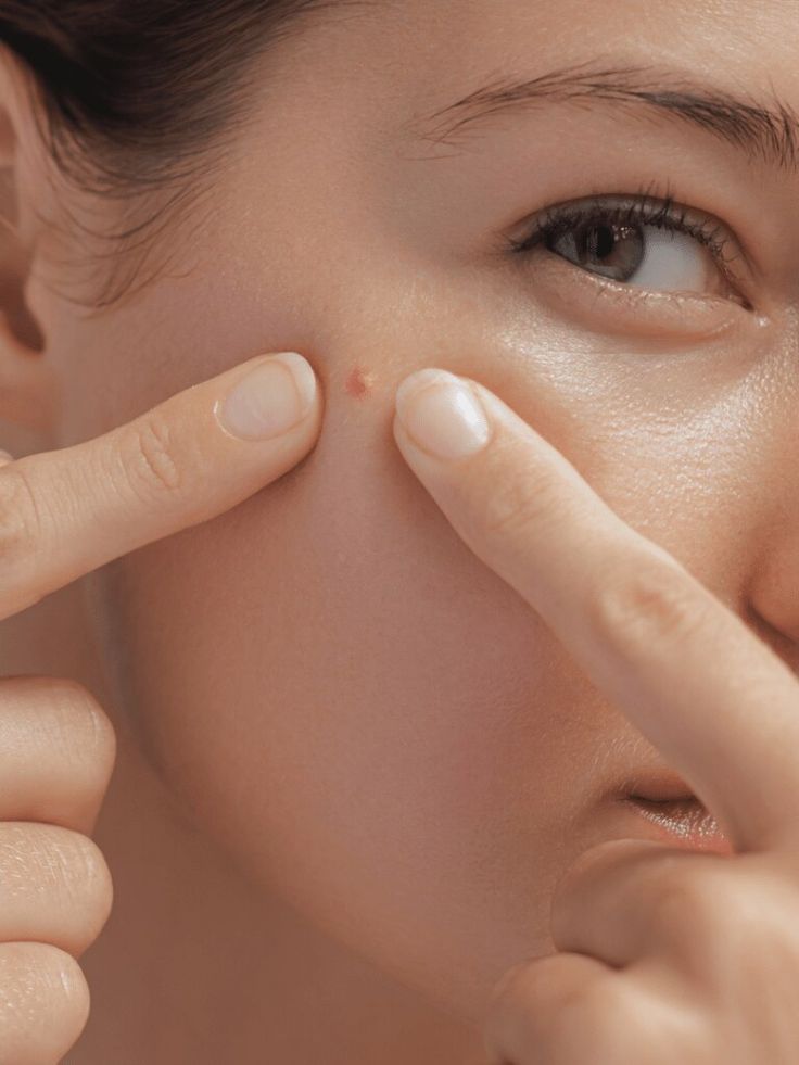 Da viêm và đỏ hơn khi cơ thể thiếu nước, khiến mụn lâu lành