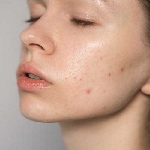 Giảm đồ uống nhiều đường và tăng thực phẩm giàu chất xơ giúp hỗ trợ da mụn
