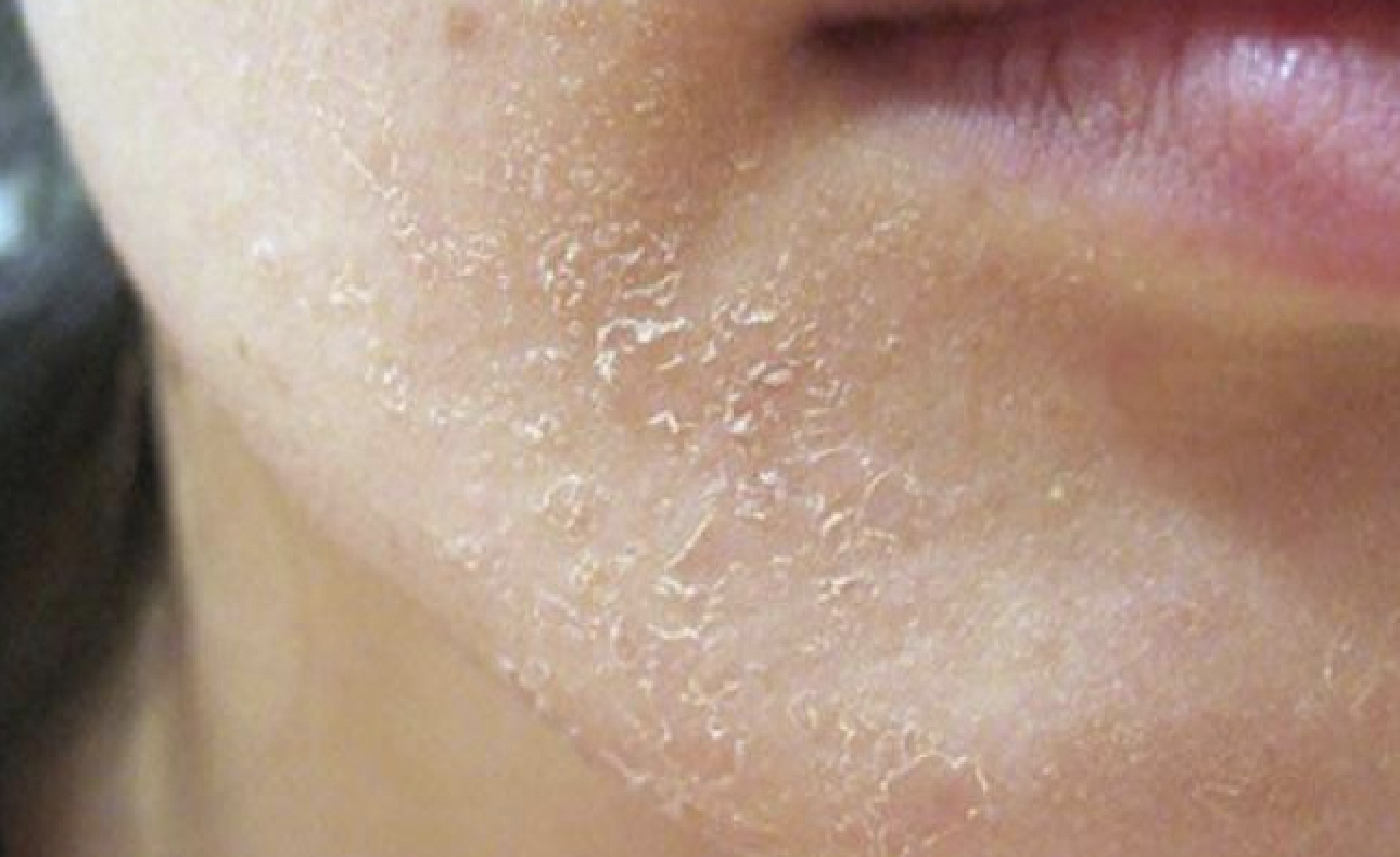Hàng rào bảo vệ da yếu sau thời gian trị mụn có thể khiến da đỏ, khô và lâu phục hồi