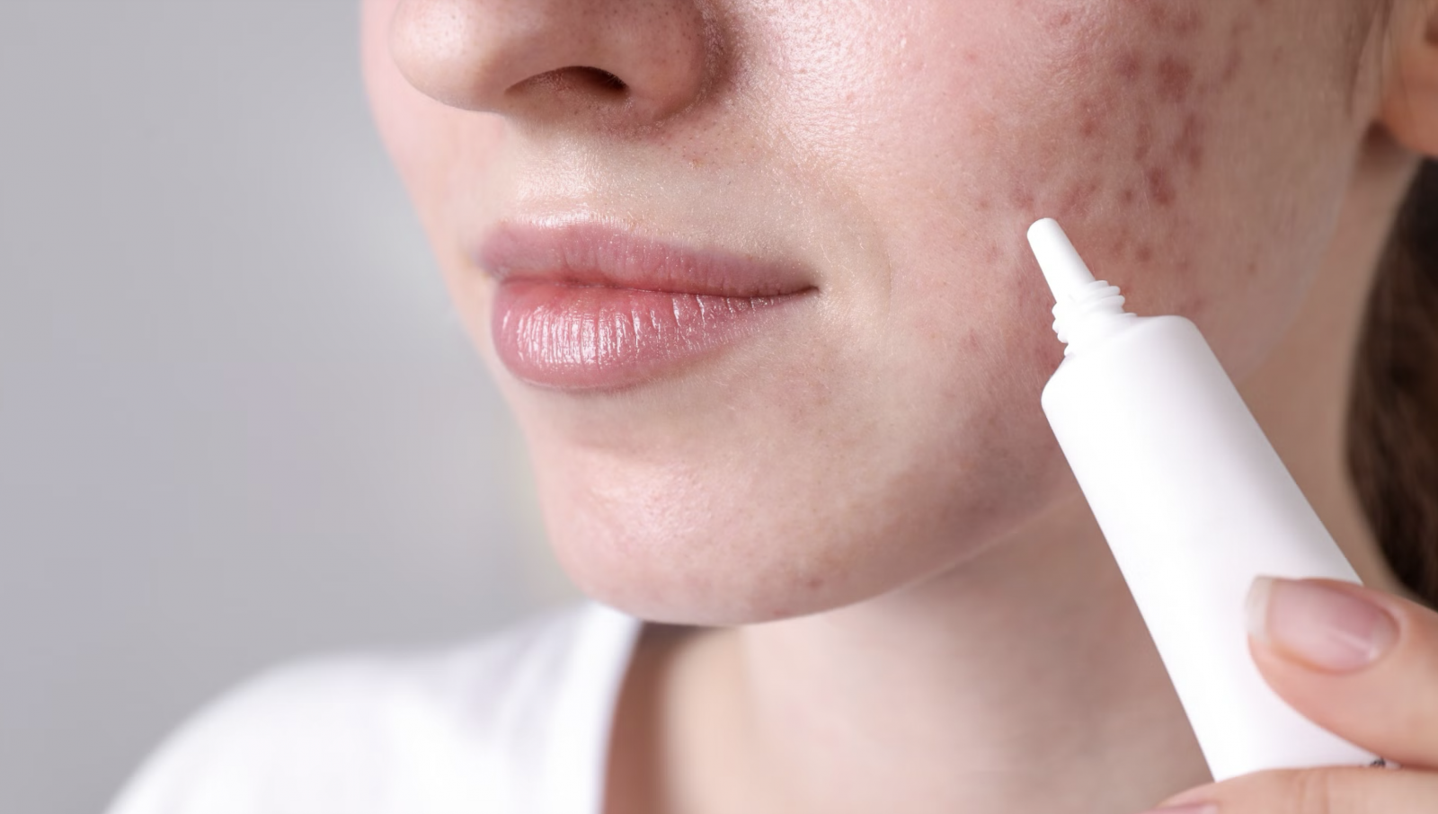 Người trưởng thành bị mụn có thể dùng tretioin