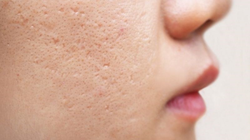 Sẹo mụn và lỗ chân lông to khiến da nhìn chưa mịn màng dù mụn đã giảm