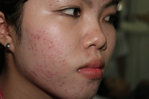 Làn da mụn đã ám ảnh tôi trong nhiều năm liền