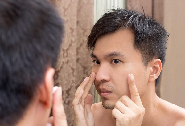 Mụn cũng xuất hiện ở nam giới khi bước vào giai đoạn tuổi dậy thì và Hormone bị rối loạn